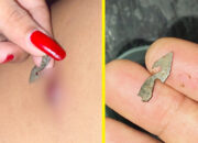 Diduga Malpraktik, Warga Rampoang Kaget Temukan Benda Asing di Luka Pascaoperasi di RSUD Palemmai Tandi